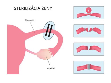 Sterilizácia pohárov