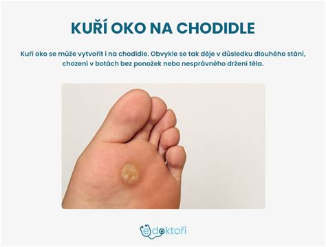 Infografika porovnávajúca kurie oko a bradavicu