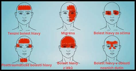 Bolesti hlavy zo zmrzliny