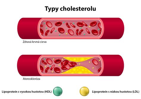 Grafické znázornenie hladiny cholesterolu v krvi a jeho vplyvu na zdravie srdca