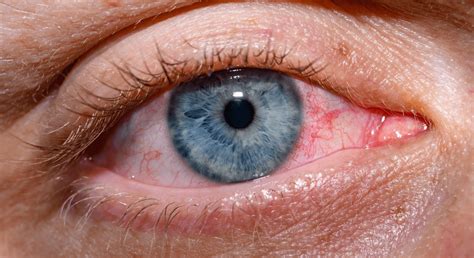 Ilustrácia alergického zápalu spojiviek