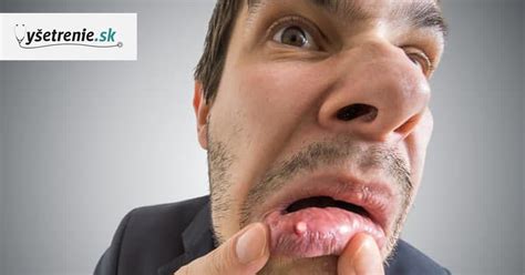 ilustrácia popálenín v ústach